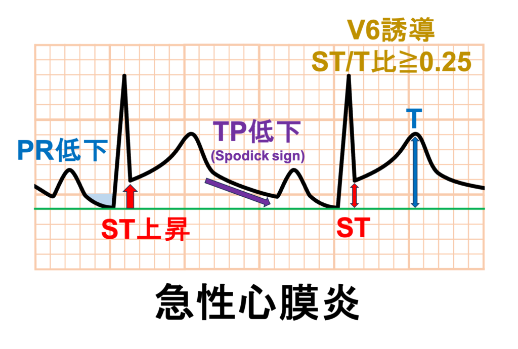 急性心膜炎(acute pericarditis)