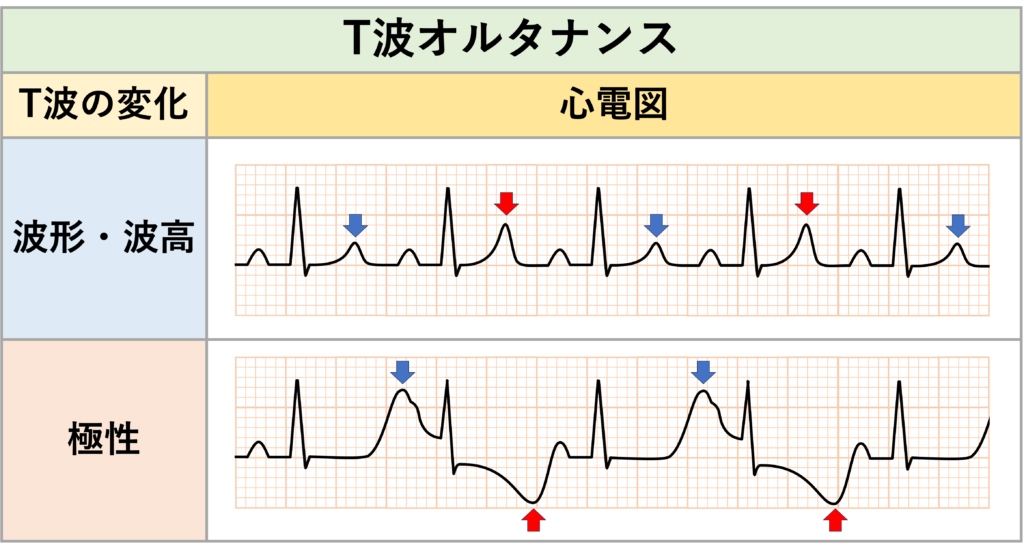 T波オルタナンス(T-wave alternans：TWA)