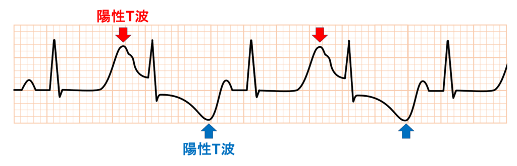 QT延長症候群8型(Long QT syndrome type 8:LQT8)