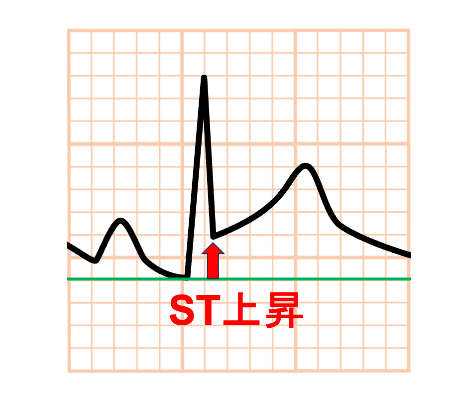 急性心膜炎(acute pericarditis)