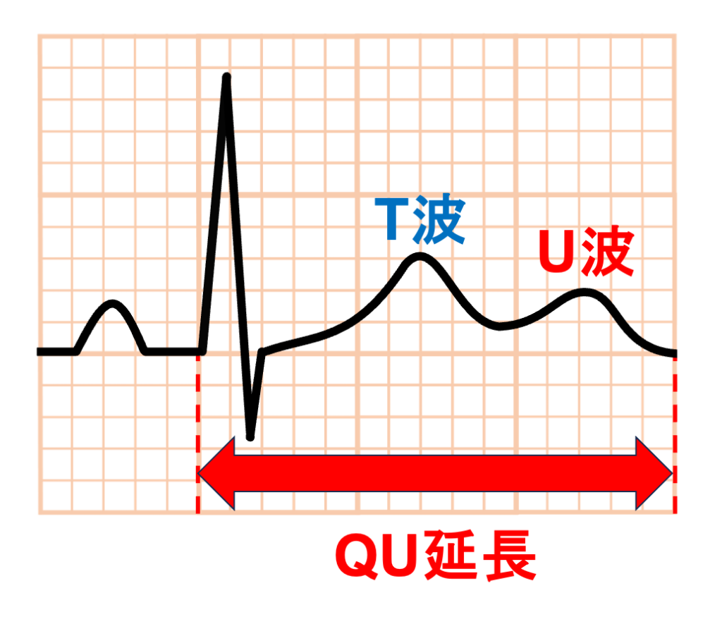 QT延長症候群7型(Long QT syndrome type 7:LQT7)
