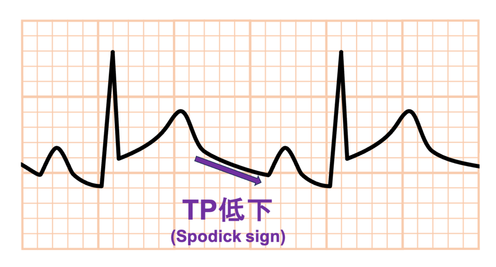 急性心膜炎(acute pericarditis)