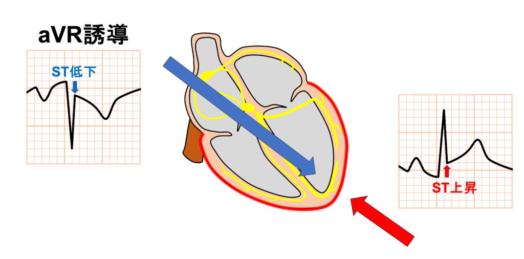 急性心膜炎(acute pericarditis)