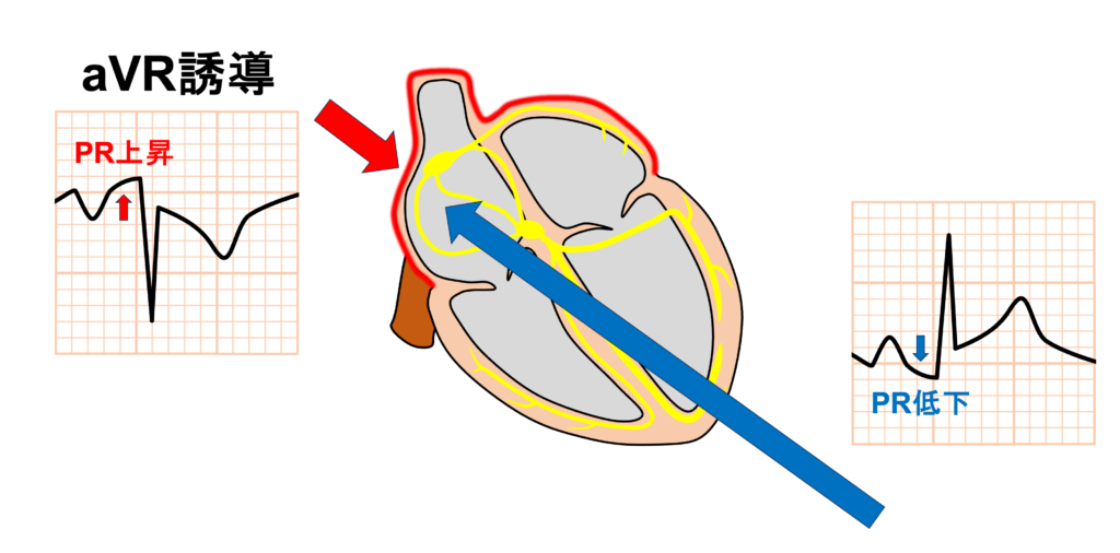 急性心膜炎(acute pericarditis)