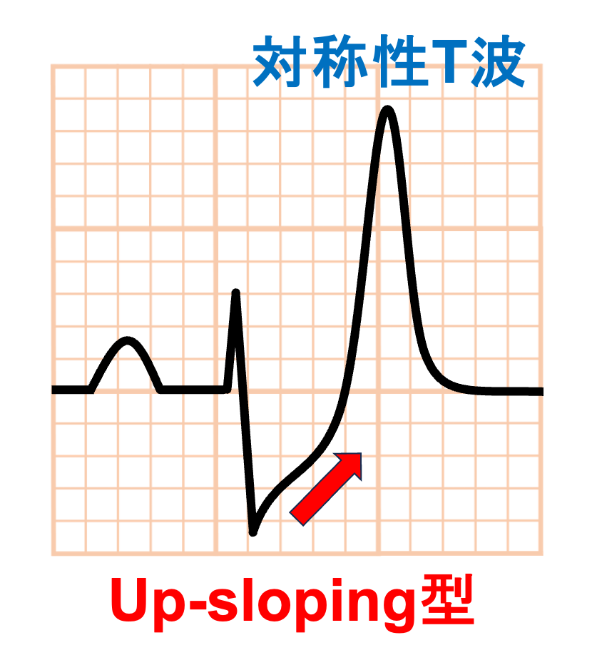 de Winter ST/T wave complex