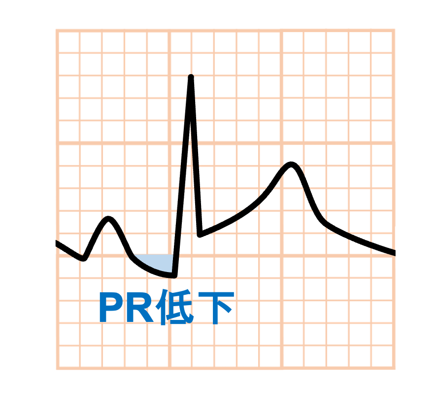 急性心膜炎(acute pericarditis)