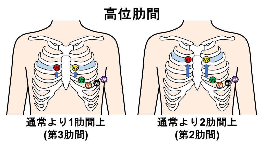 ブルガダ症候群(Brugada syndrome)