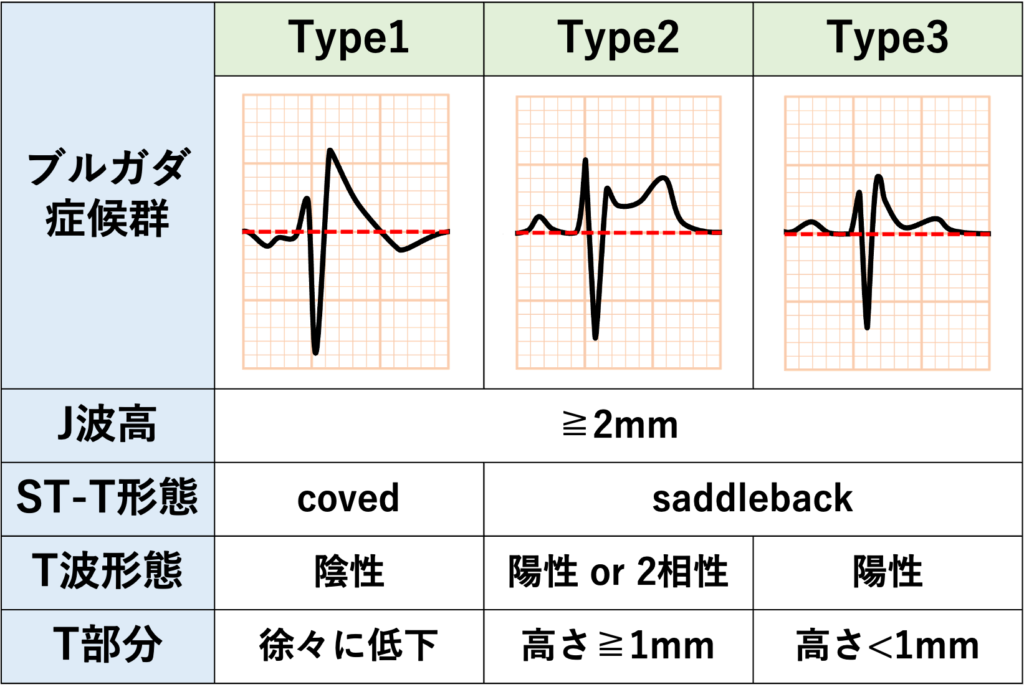 ブルガダ症候群(Brugada syndrome)
