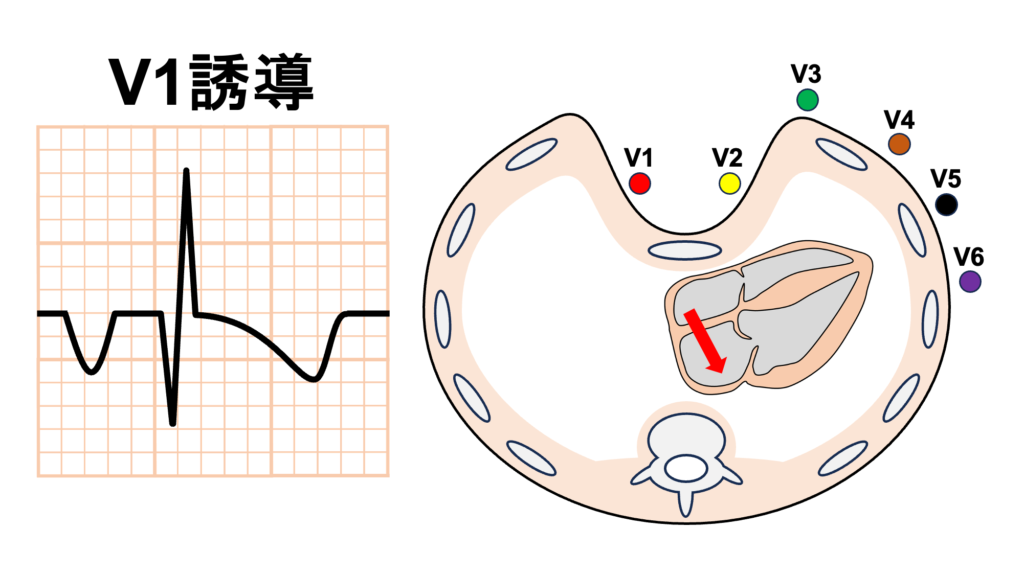 漏斗胸(pectus excavatum)
