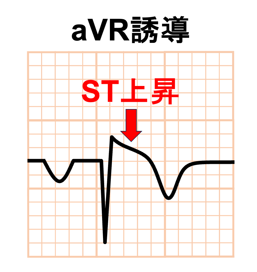 de Winter ST/T wave complex