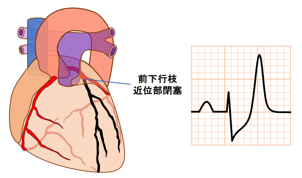 de Winter ST/T wave complex