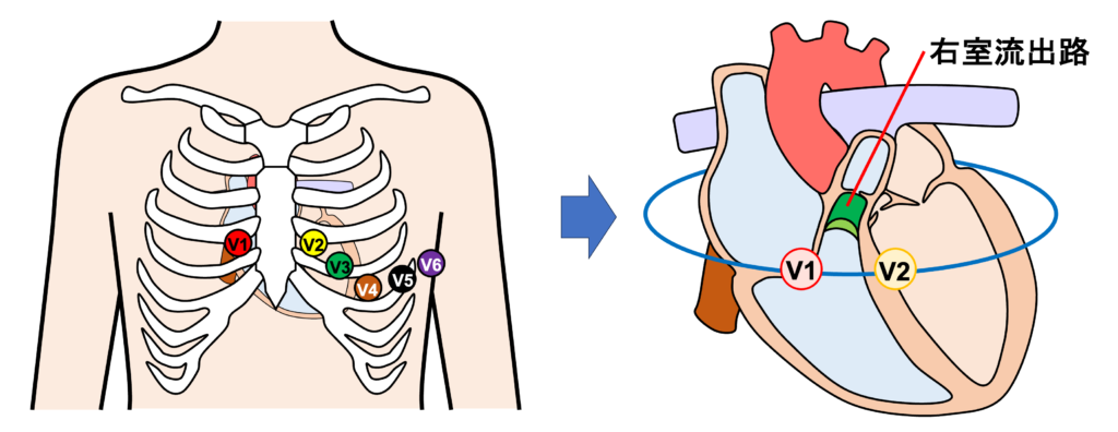 ブルガダ症候群(Brugada syndrome)