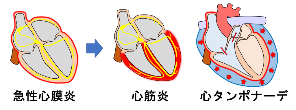 急性心膜炎(acute pericarditis)