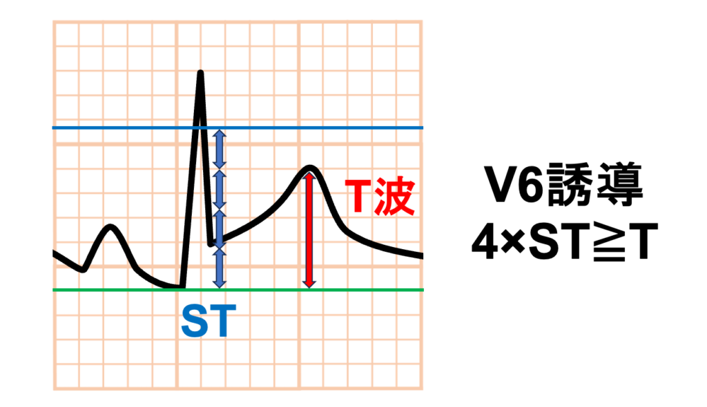 急性心膜炎(acute pericarditis)