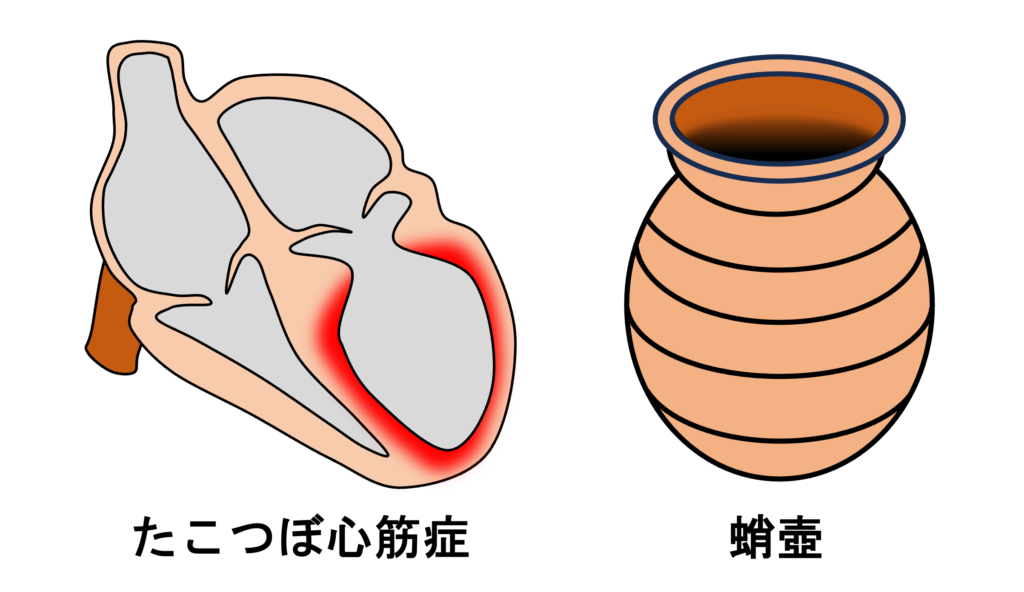 たこつぼ心筋症(Takotsubo Cardiomyopathy)