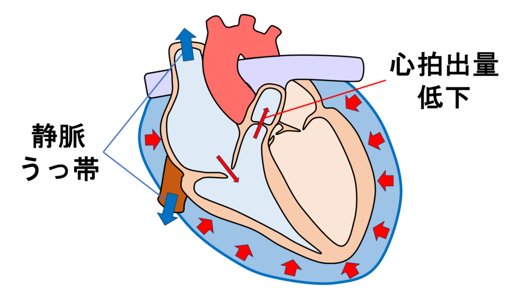 心タンポナーデ(cardiac tamponade)