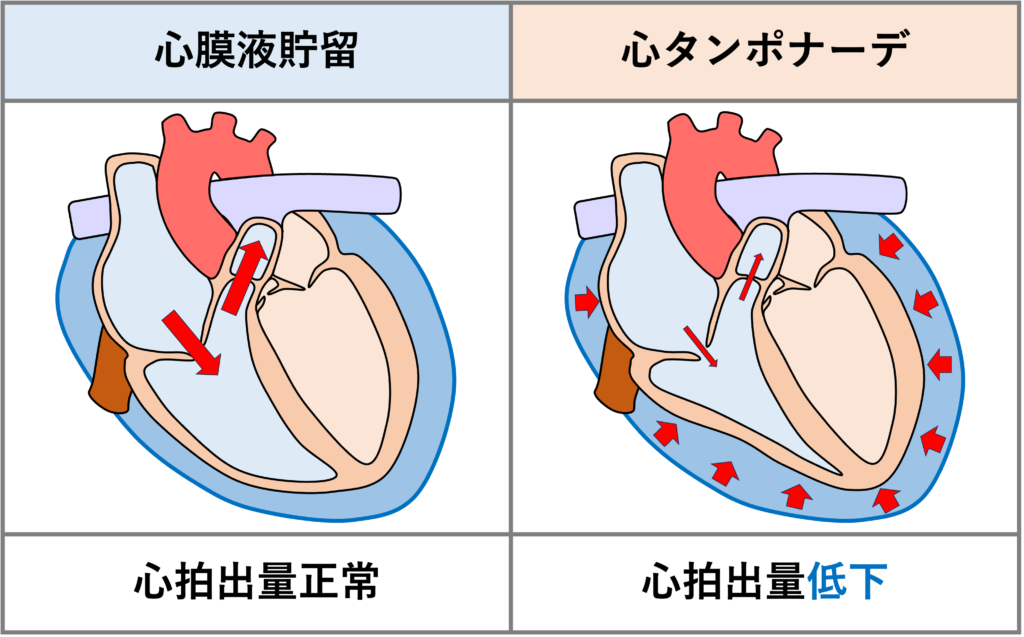 心タンポナーデ(cardiac tamponade)