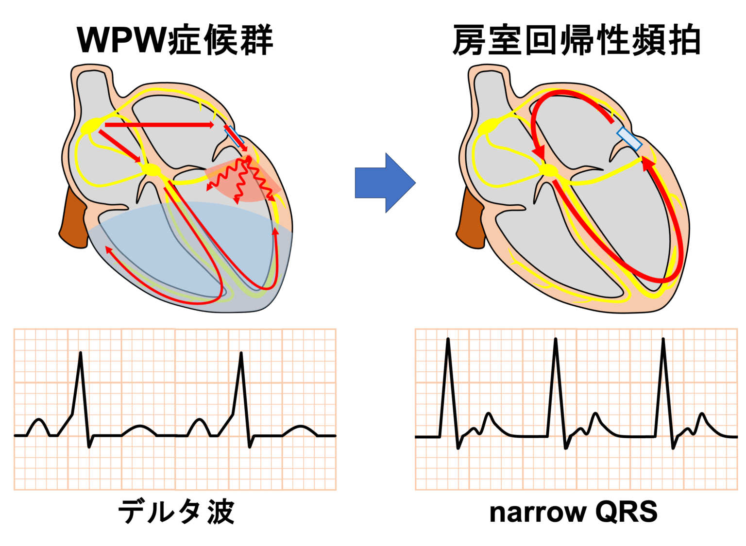 房室回帰性頻拍(AVRT)とは? | 心電図.com
