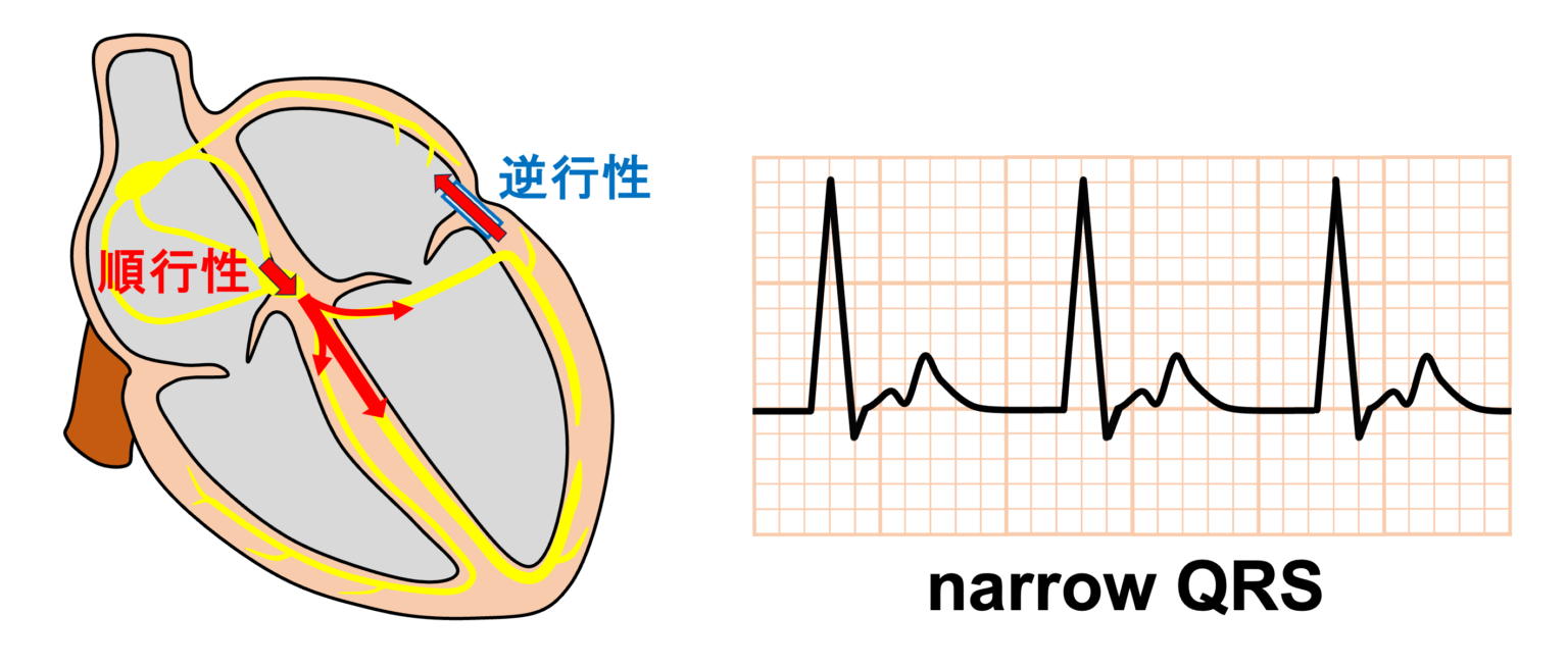 房室回帰性頻拍(AVRT)とは? | 心電図.com