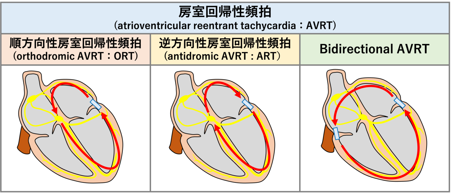 房室回帰性頻拍(AVRT)とは？ | 心電図.com