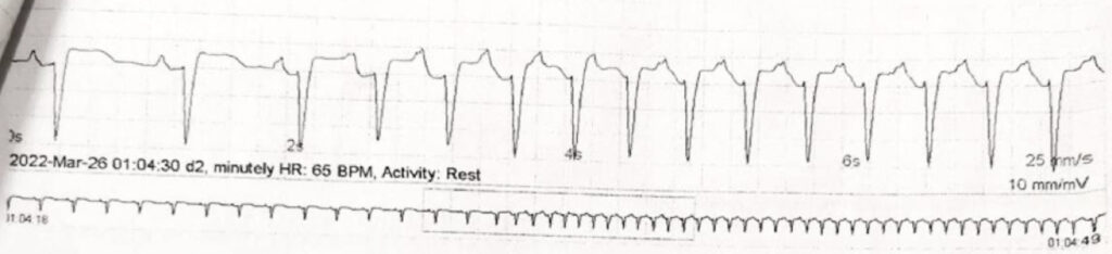 房室回帰性頻拍(atrioventricular reentrant tachycardia:AVRT)