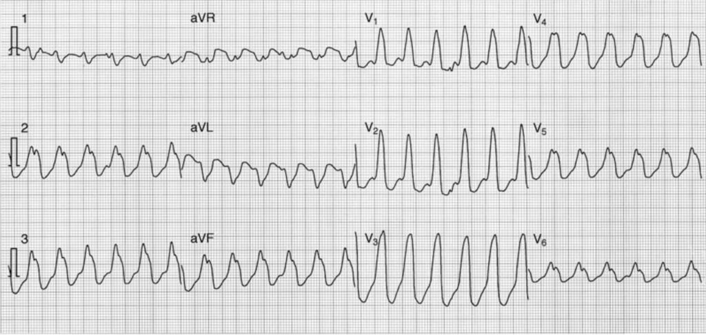 precordial concordance