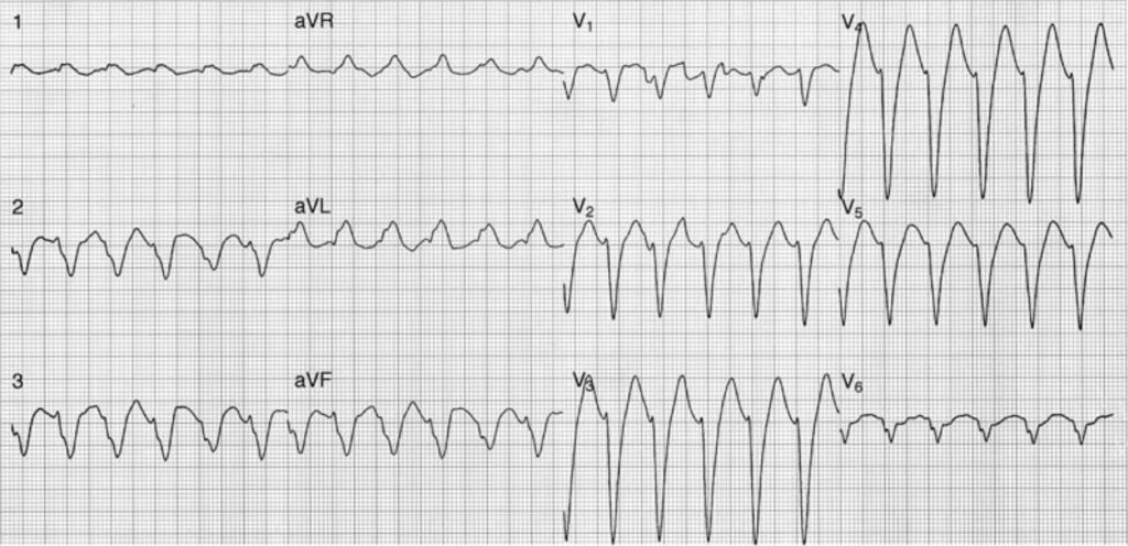 precordial concordance
