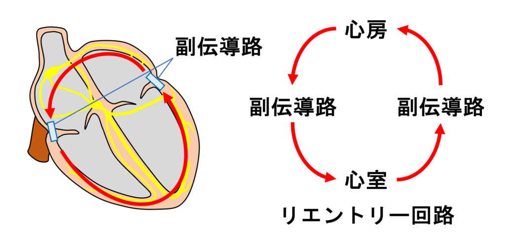 房室回帰性頻拍(atrioventricular reentrant tachycardia:AVRT)