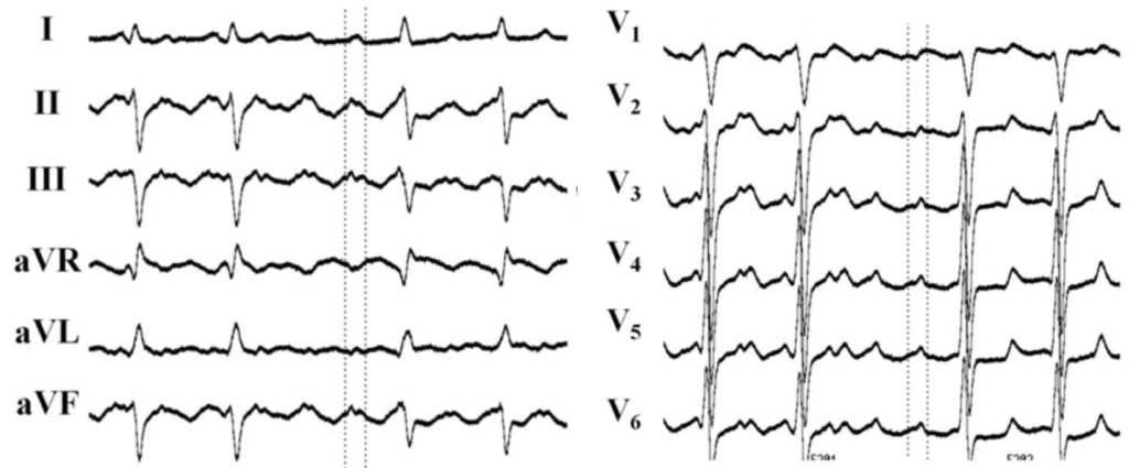 心房粗動(Atrial flutter)