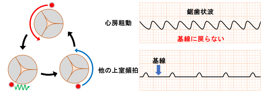 心房粗動(Atrial flutter)