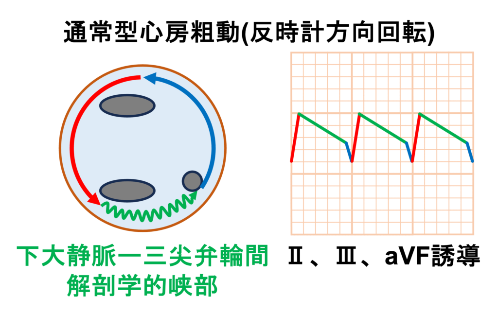 心房粗動(Atrial flutter)