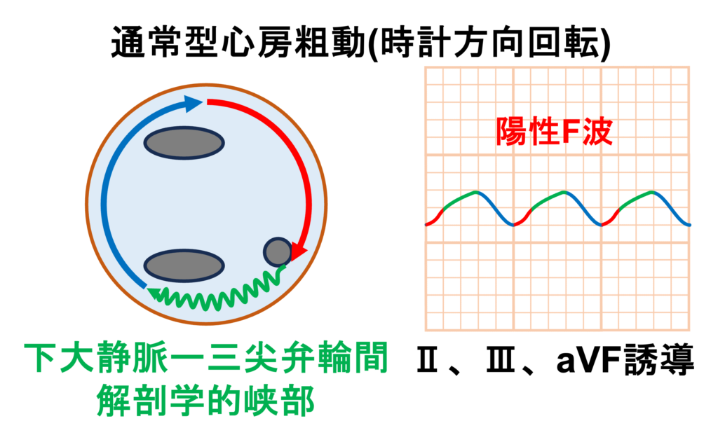 心房粗動(Atrial flutter)