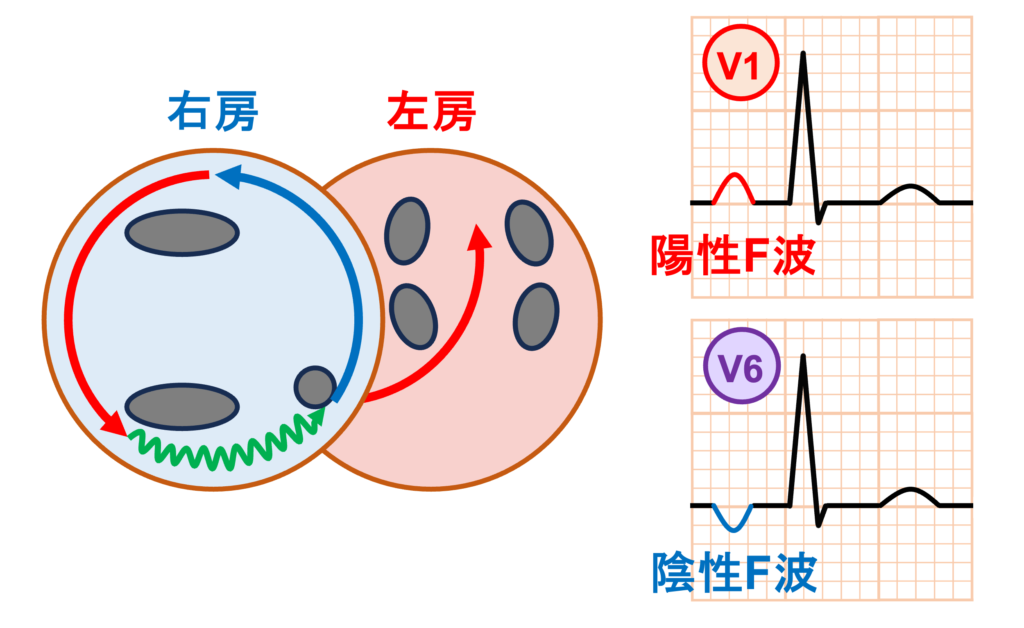 心房粗動(Atrial flutter)