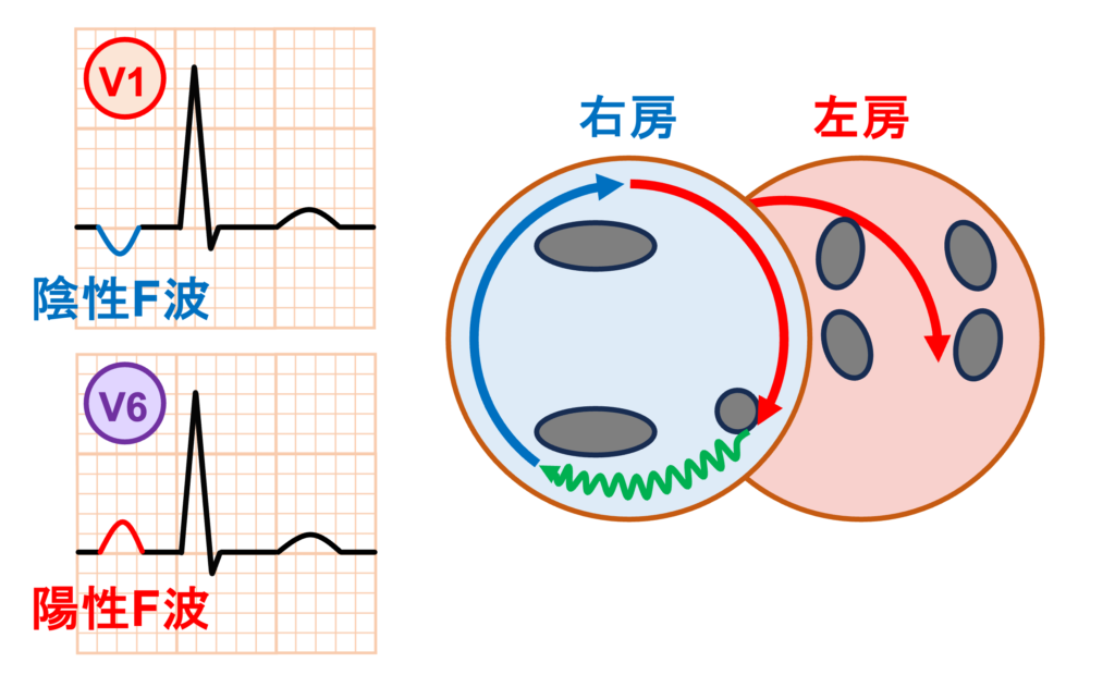 心房粗動(Atrial flutter)