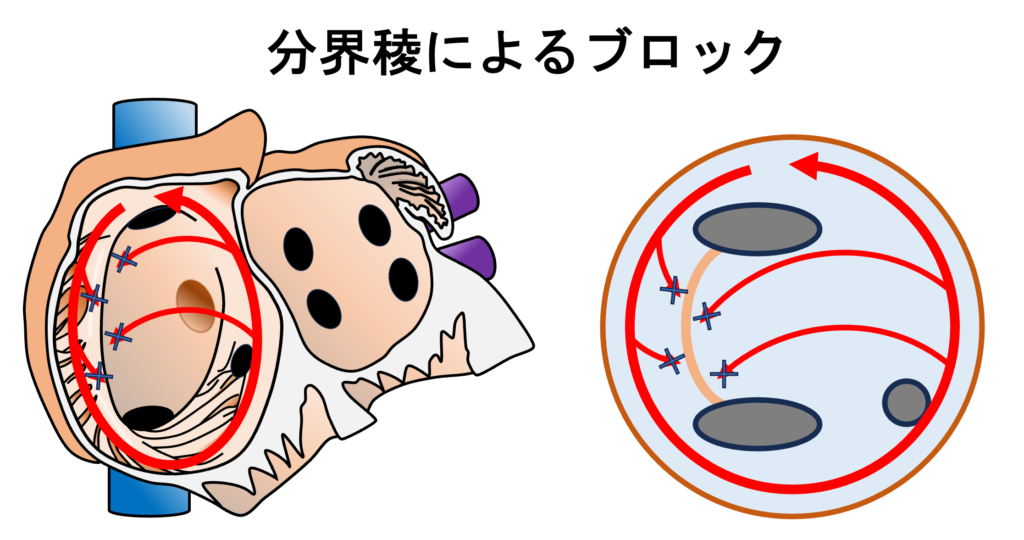 心房粗動(Atrial flutter)