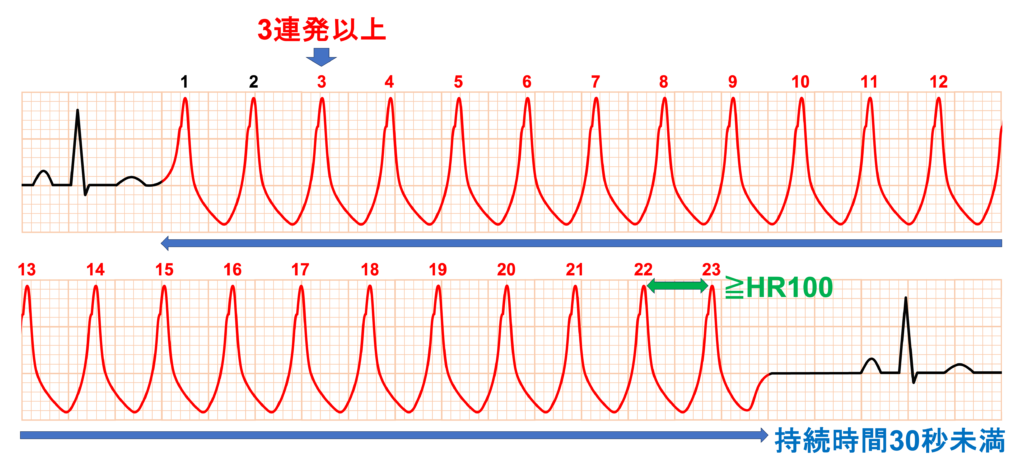 非持続性心室頻拍(Non-sustained ventricular tachycardia: NSVT)