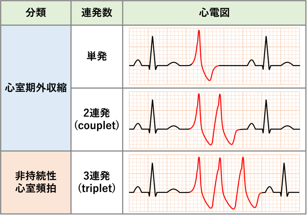 非持続性心室頻拍(Non-sustained ventricular tachycardia: NSVT)
