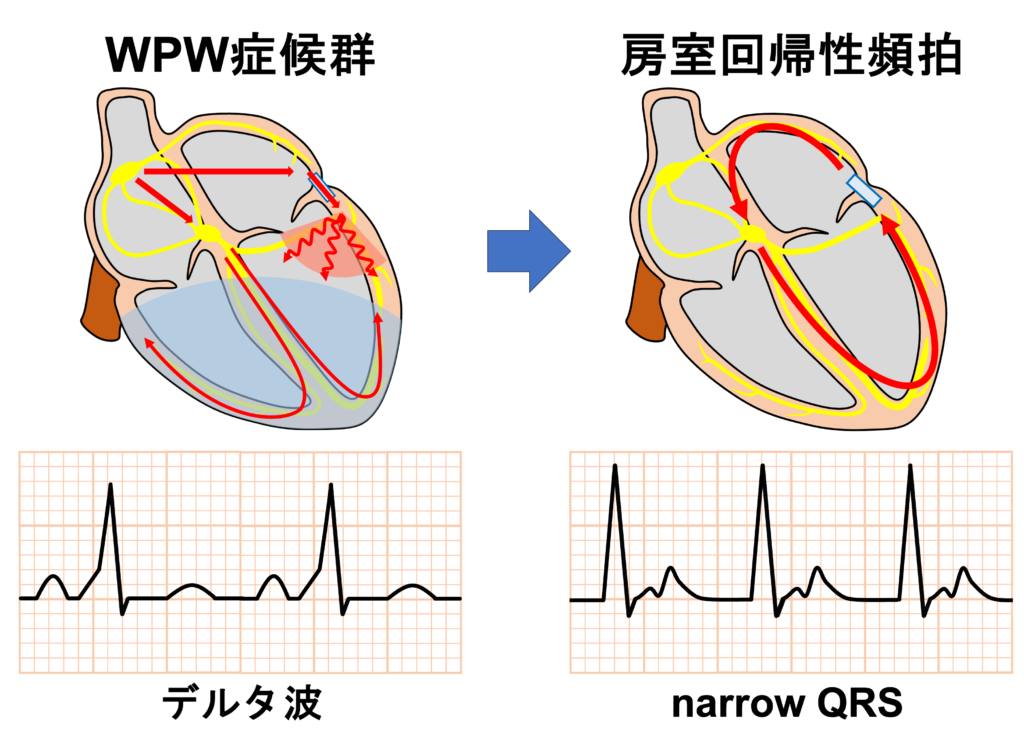 房室回帰性頻拍(atrioventricular reentrant tachycardia:AVRT)