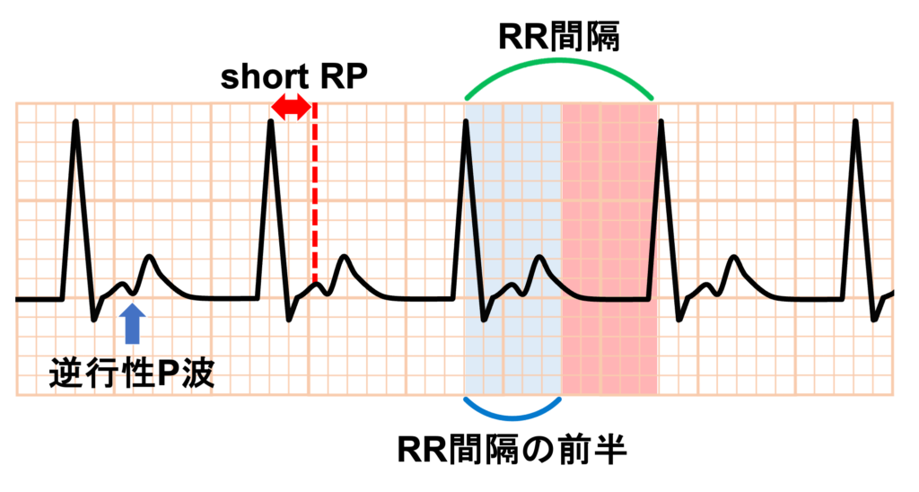 房室回帰性頻拍(atrioventricular reentrant tachycardia:AVRT)