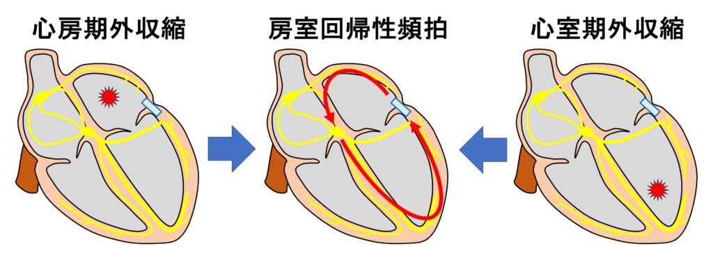房室回帰性頻拍(atrioventricular reentrant tachycardia:AVRT)