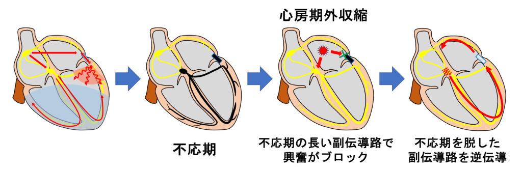 房室回帰性頻拍(atrioventricular reentrant tachycardia:AVRT)
