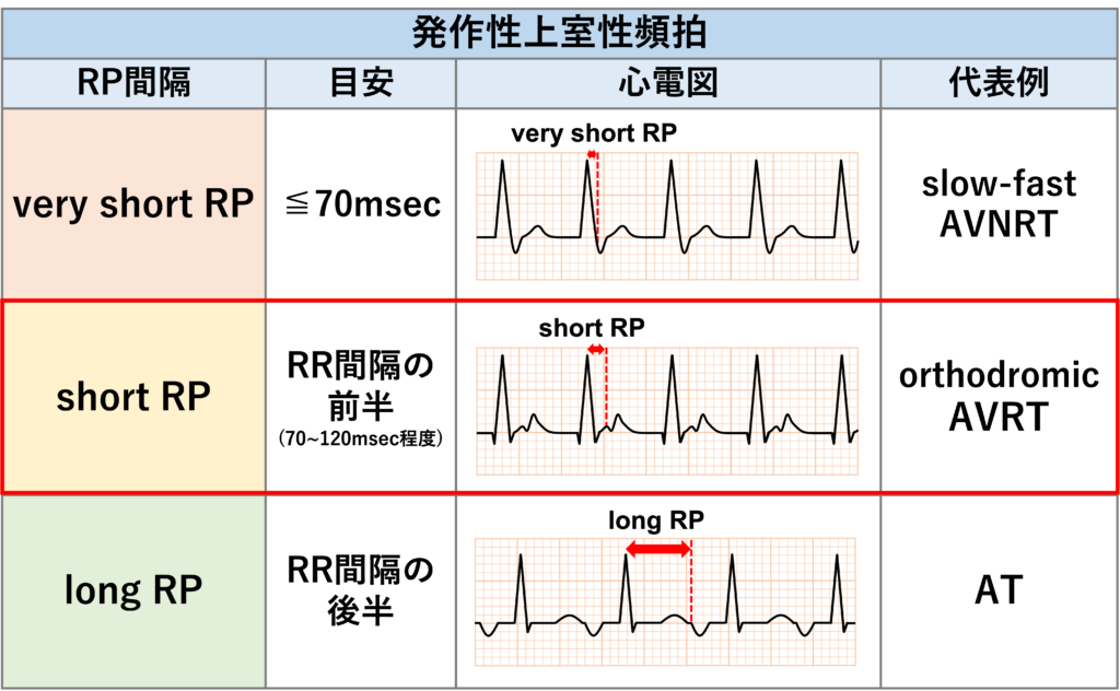 房室回帰性頻拍(atrioventricular reentrant tachycardia:AVRT)