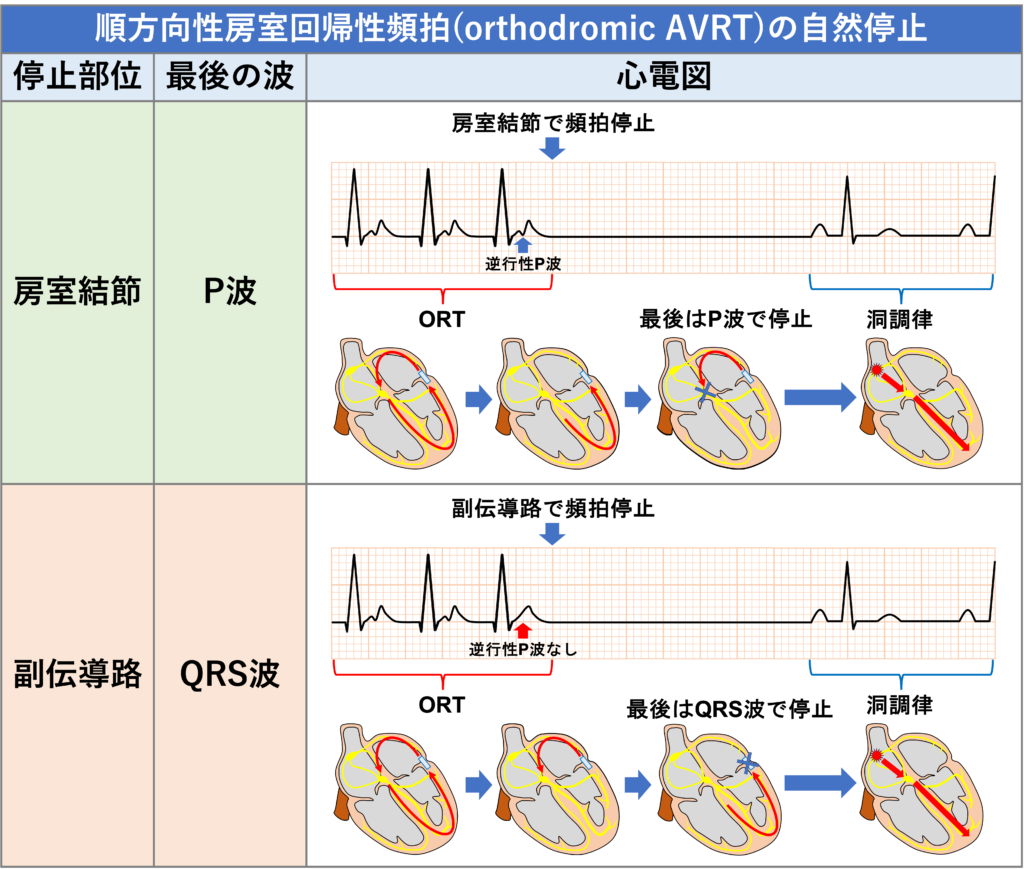 房室回帰性頻拍(atrioventricular reentrant tachycardia:AVRT)