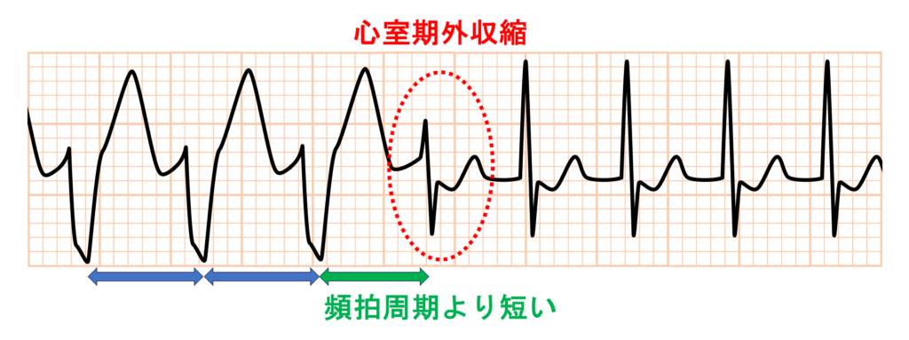 クーメル現象(coumel phenomenon)