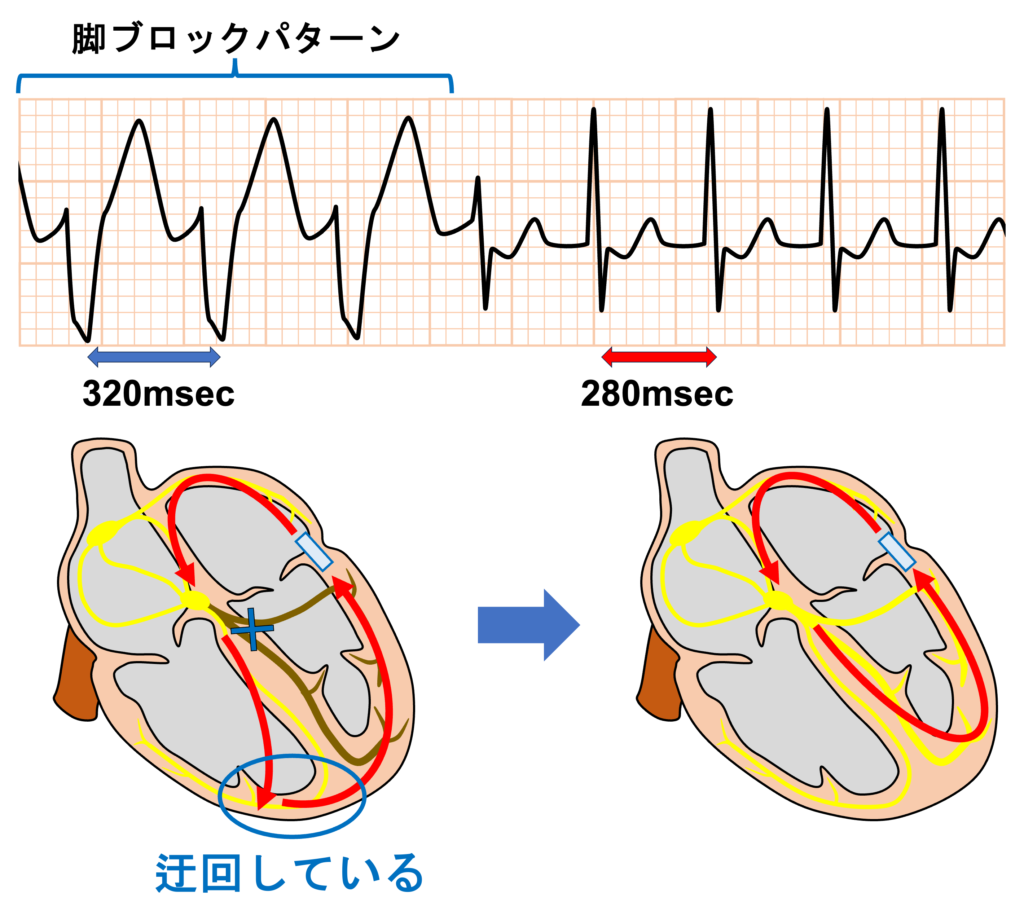 クーメル現象(coumel phenomenon)