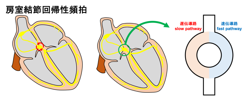 房室結節回帰性頻拍(atrioventricular nodal reentrant tachycardia:AVNRT)