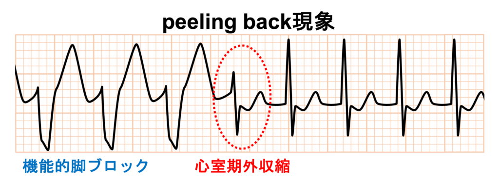 peeling back現象
