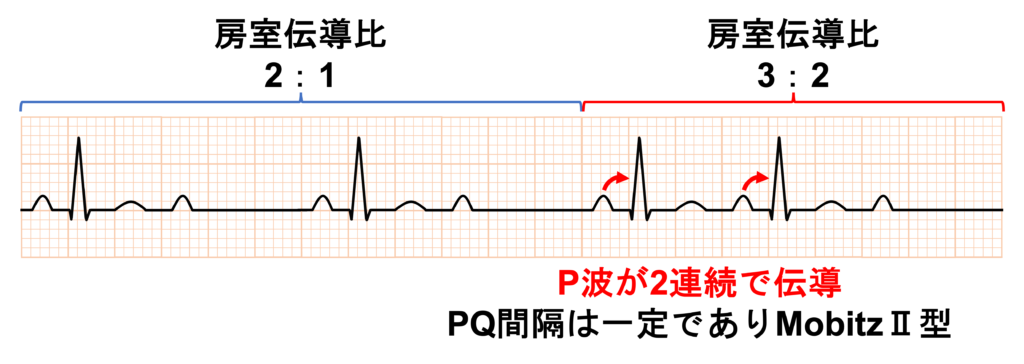 2：1房室ブロック(2：1 atrioventricular block)