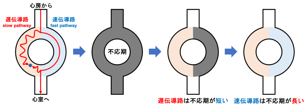房室結節回帰性頻拍(atrioventricular nodal reentrant tachycardia:AVNRT)