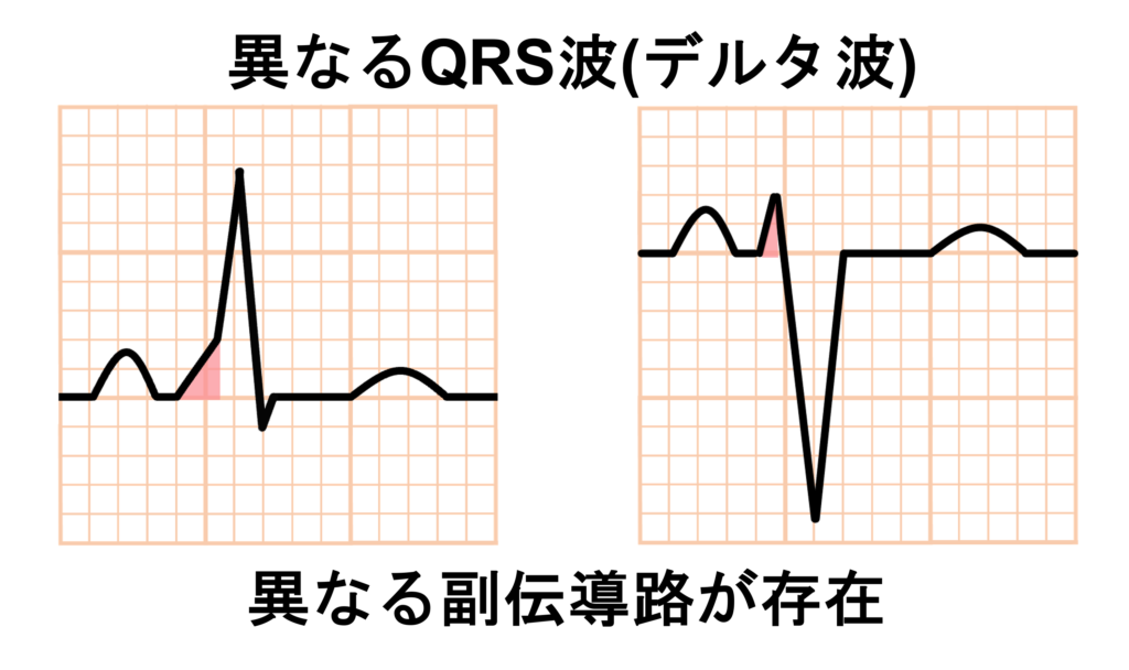 複数副伝導路(Multiple accessory pathway)
